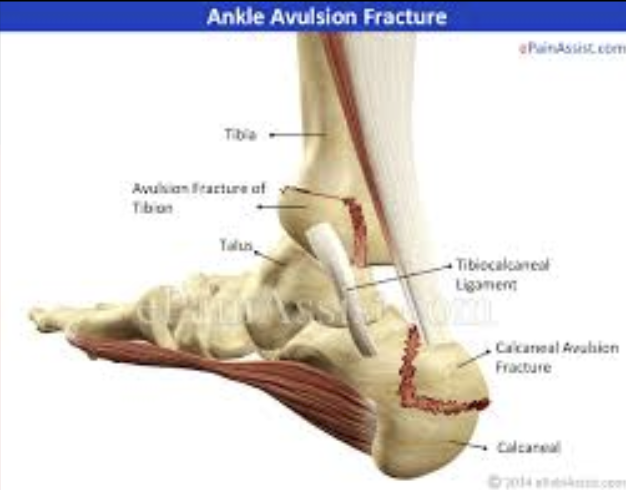 <p><span style="font-family: &quot;Trebuchet MS&quot;, sans-serif">A ligament or tendon pulls away from its attachment on the bone and a fragment of the bone breaks with it.</span></p>