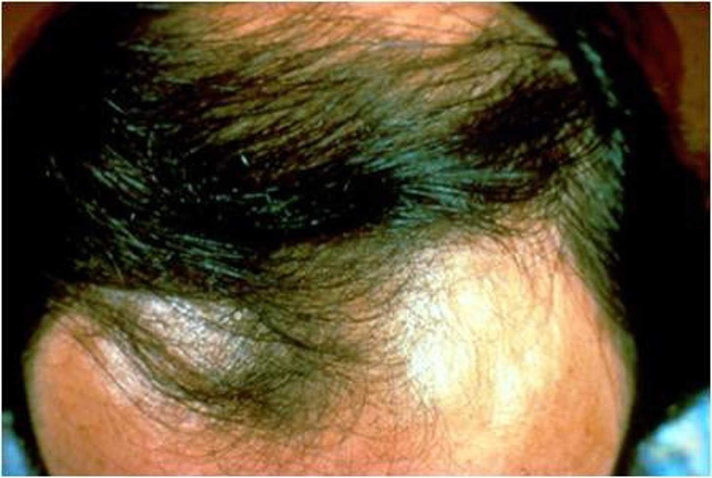 <p>Androgenic Alopecia</p>