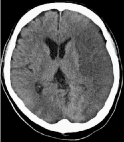 <p>Middle Cerebral Artery (MCA) Obstruction</p>