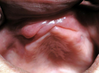 <p>Terms used to describe the surface texture of a lesion</p>