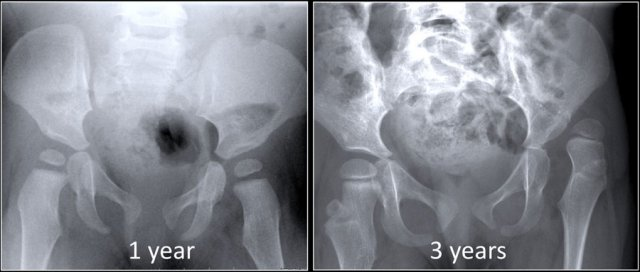 <p>Congenital dislocation of hip</p>