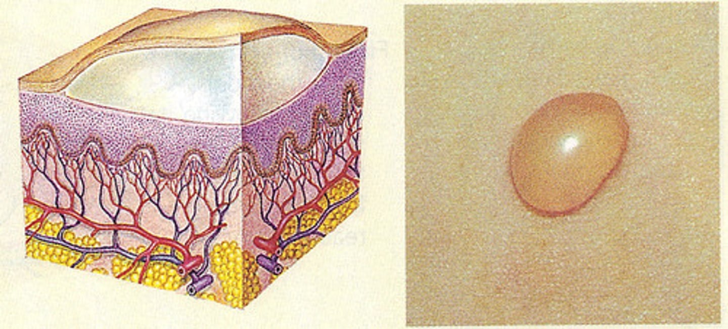 <p>large, fluid-filled blister</p><p>>0.5 cm</p>