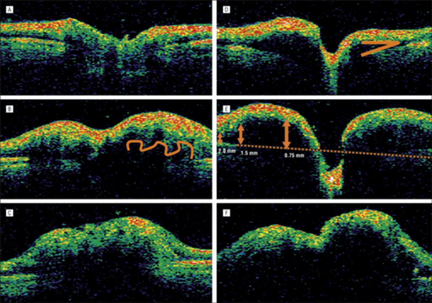 <p>papilledema = rounded, regular elevation +/- lazy V sign</p><p>drusen = irregular elevation</p>