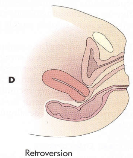 <ul><li><p>A <strong>tipping backward</strong> of the uterus <u>without a bend</u> between the cervix and body</p></li><li><p>Approx. 10% of population</p></li></ul><p></p>