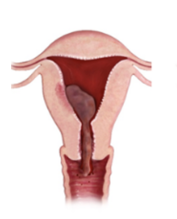 <p>Treatment plan for incomplete abortion</p>