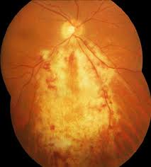 <p>bushfire retinopathy </p><p></p>