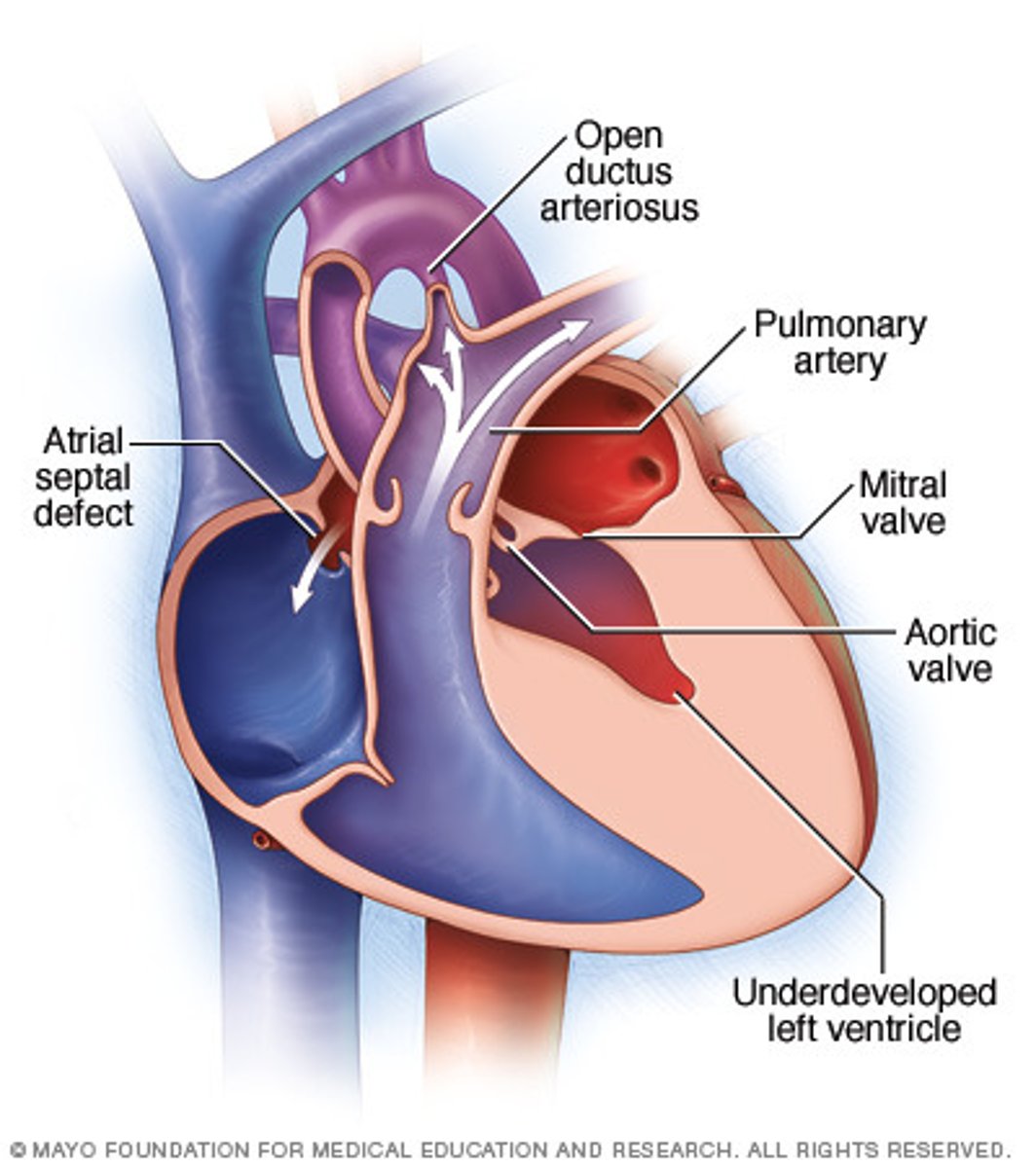 <p>Underdevelopment of the LV &amp; left-sided heart structures; stenosis/atresia of the mitral &amp; aortic valves</p>