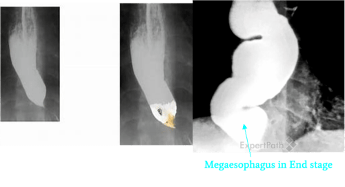 <p>Define Condition:</p><p>Type of Dysmotility disorder (process that interferes w/ coordinated waves of peristaltic contractions) characterized by certain Sx</p><p>-Hx: IDIOPATHIC</p><p>&gt; Develops slowly over weeks to years (Sx increase as disease progresses)</p><p>-Path: D/t failure of distal esophageal inhibitory neurons in Myenteric (Auerbach) plexus (Neurodegenerative Disorder) ==&gt; Less relaxation of LES/MORE CONTRACTION</p><p>-Sx/Dx: (Dx Triad)</p><p>&gt; Esophageal Aperistalsis</p><p>&gt; Impaired LES relaxation</p><p>&gt; Increased LES tone</p><p>&gt; Other Sx =</p><p>&gt;&gt; PROGRESSIVE Dysphagia (Food --&gt; Liquid)</p><p>&gt;&gt; Heartburn (d/t retention of acid/noxious food contents)</p><p>&gt;&gt; Bad breath/Foul-Smelling Burp (d/t undigested retained food in esophagus)</p><p>&gt;&gt; Chest Pain/Wt Loss/Regurgitation/Nocturnal Cough (d/t stasis and retention of food &amp; liquids)</p><p>&gt;&gt; Pulm Issues (Recurrent aspiration, tracheal compression from dilated eosphagus)</p><p>-Dx:</p><p>&gt; Esophageal Manometry (HIGHEST SENSITIVTY)</p><p>&gt;&gt; Pressure change w/ contraction</p><p>&gt;&gt; Shows Increase LES Tone</p><p>&gt; Barium swallow study = Dilated Esophagus</p><p>&gt;&gt; "Bird's beak" deformity</p>