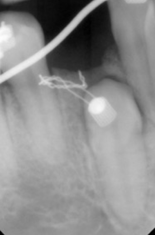 <p><strong>Fully expose the crown</strong>&nbsp;and cement it to&nbsp;<strong>an orthodontic button</strong> for traction- pull tooth into position&nbsp;<br>Canines in an <strong>unfavorable position</strong> with <strong>no eruptive potential</strong></p>