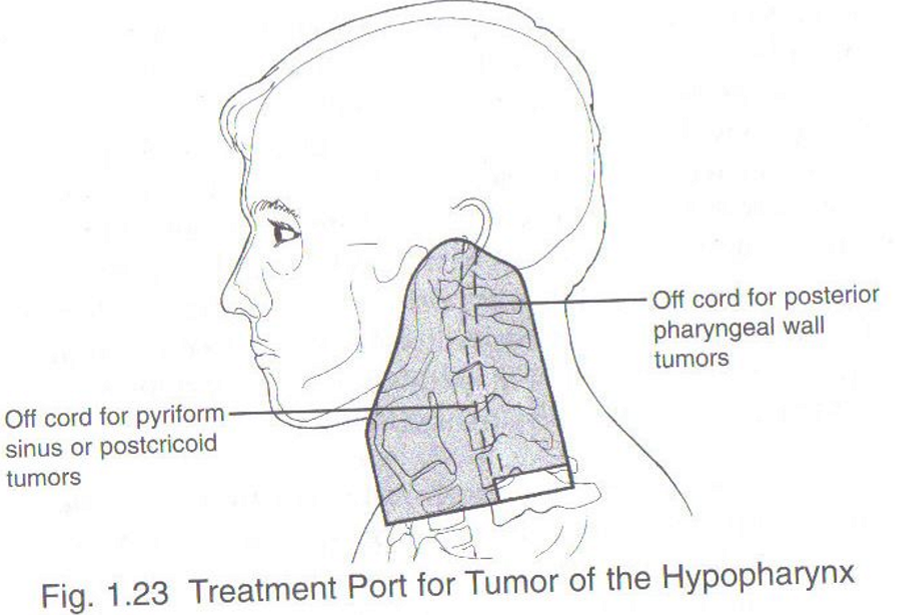 <p>sup: inf border of mandible and mastoid process to base of skull</p><p>inf: inf of cricoid cartilage to encompass extent of tumor + 1.5-2.0 cm</p><p>ant: anterior to thyroid cartilage with a margin around tumor extension</p><p>post: post to the spinous processes with a margin around all nodal disease</p>