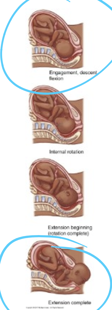 <p><strong>engagement</strong>: when the fetal presenting part is even (station 0) with the ischial spine, this is the start of the cardinal movements of labor </p><p><strong>extension</strong>: fetal head has to get underneath the pubic bone</p><ul><li><p>LOA and ROA most favorable</p></li></ul>