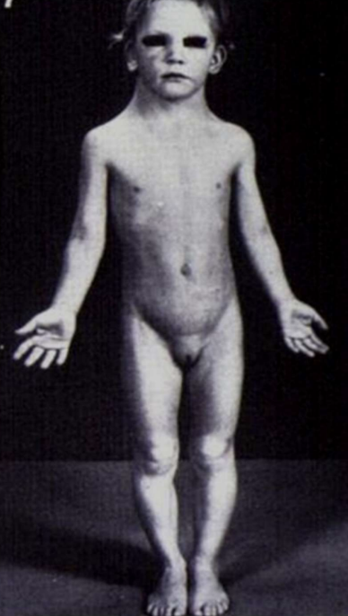 <p>Monosomy X condition with short stature, webbed neck, shield chest, streak ovaries, coarctation of aorta, infertility.</p>