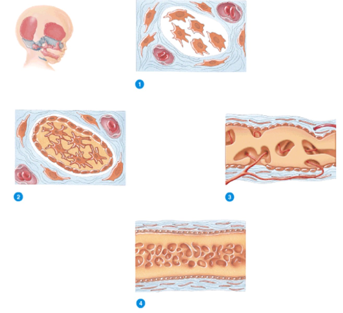 <p>The process by which bone develops directly from mesenchymal tissue. Bone forms directly from soft tissue (like a flat bone of the skull forming from a soft sheet).</p>