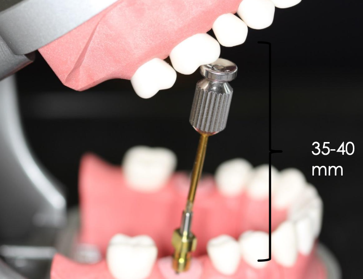 <p>What are some contraindications of using the open tray impression technique?</p>