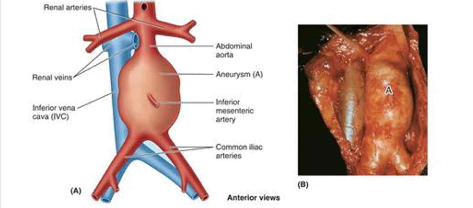<p>Abnormal &amp; excessive dilation or ballooning of abdominal aorta</p><p>Acute rupture = FATAL (90%)</p>