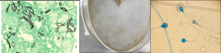 <p><span style="font-family: &quot;Times New Roman&quot;, serif; line-height: 107%;"><span>Classical association: bovine abortion (“mucormycosis”)</span></span></p><p class="MsoListParagraphCxSpMiddle"><span style="font-family: &quot;Times New Roman&quot;; line-height: normal; font-size: 7pt;"><span> </span></span><span style="font-family: &quot;Times New Roman&quot;, serif; line-height: 107%;"><span>Histology: aseptate broad hyphae, irregular width, wide angle branching</span></span></p><p class="MsoListParagraphCxSpMiddle"><span style="font-family: &quot;Times New Roman&quot;, serif; line-height: 107%;"><span>Culture: fluffy mould on Sam</span></span></p><p class="MsoListParagraphCxSpLast"><span style="font-family: &quot;Times New Roman&quot;, serif; line-height: 107%;"><span>Microscopy: sporangium filled with sporangiospores</span></span></p><p class="MsoListParagraphCxSpLast"><span style="font-family: &quot;Times New Roman&quot;, serif; line-height: 107%;"><span>What is it?</span></span></p>