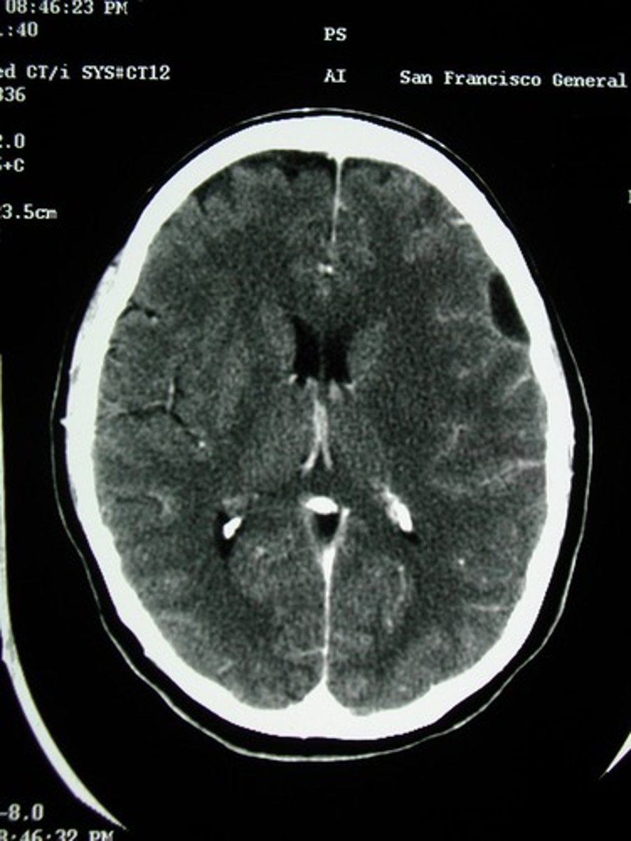 <p>Define Condition:</p><p>Collection of pus between the outer covering of the brain and spinal cord and the bones of the skull or spine</p><p>-Due to adjacent sinusitis or osteomyelitis</p><p>-Dx: IICP, Herniation, LP = HIGH PROTEIN, PMNs</p><p>-Tx: surgical emergency if spinal involvement</p>