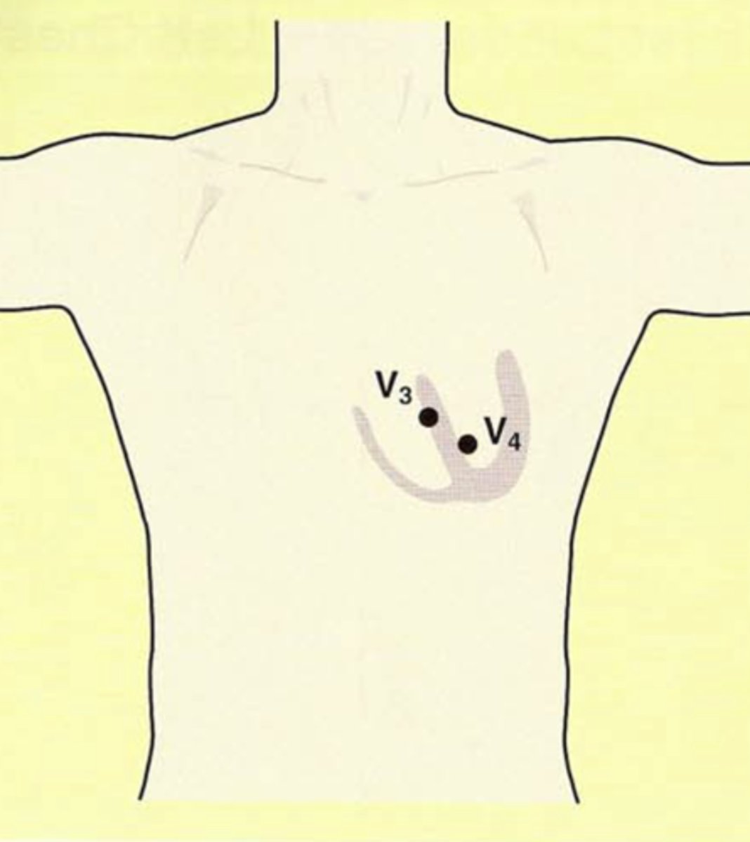 <p>over the intraventricular septum</p>