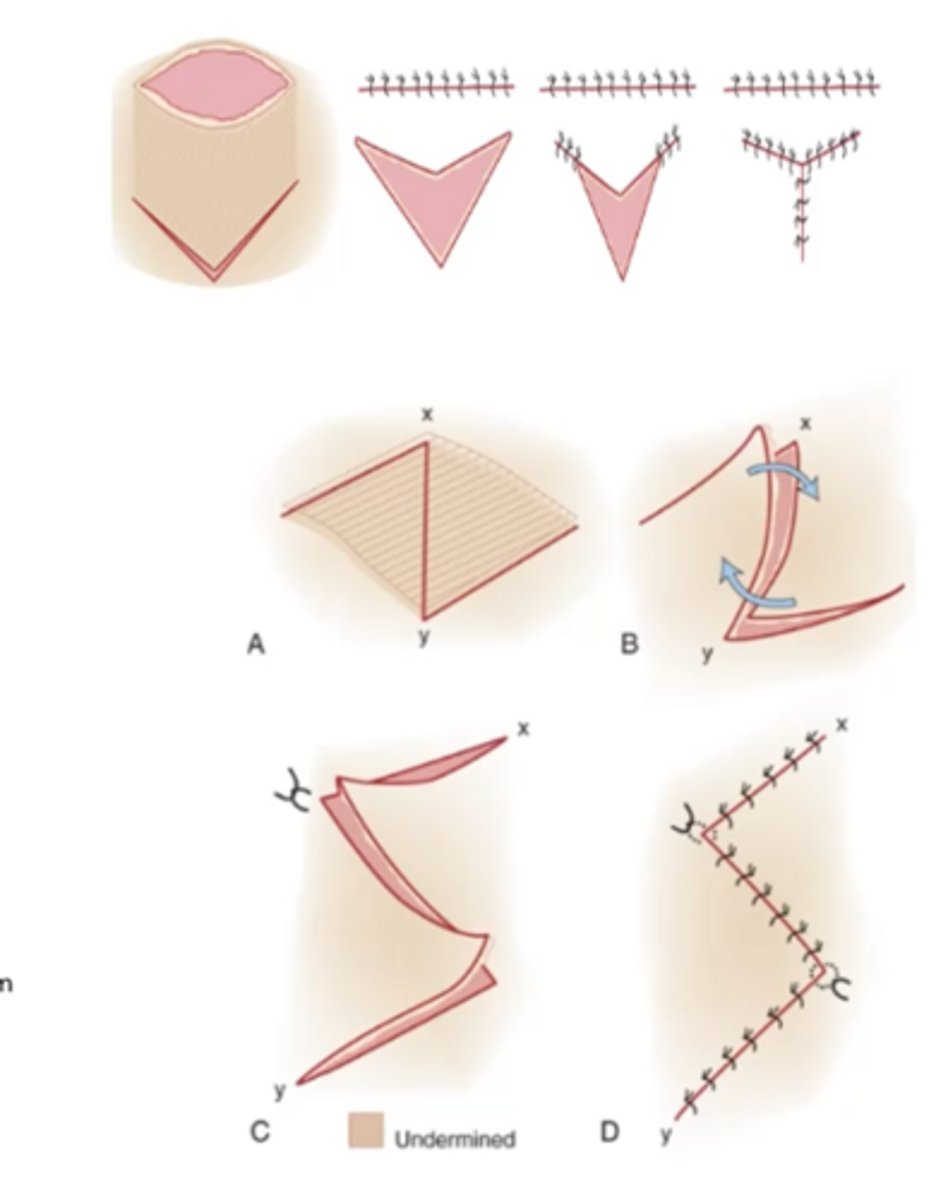 <p>V to Y, where you cut a V next to the incision and sew it as a Y, and</p><p>Z plasty, where you cut a Z and swap the two triangles position</p>