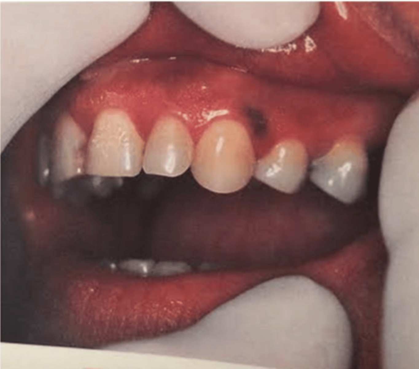<p>response to healing</p><p>• common locations: gingival/buccal mucosa </p>