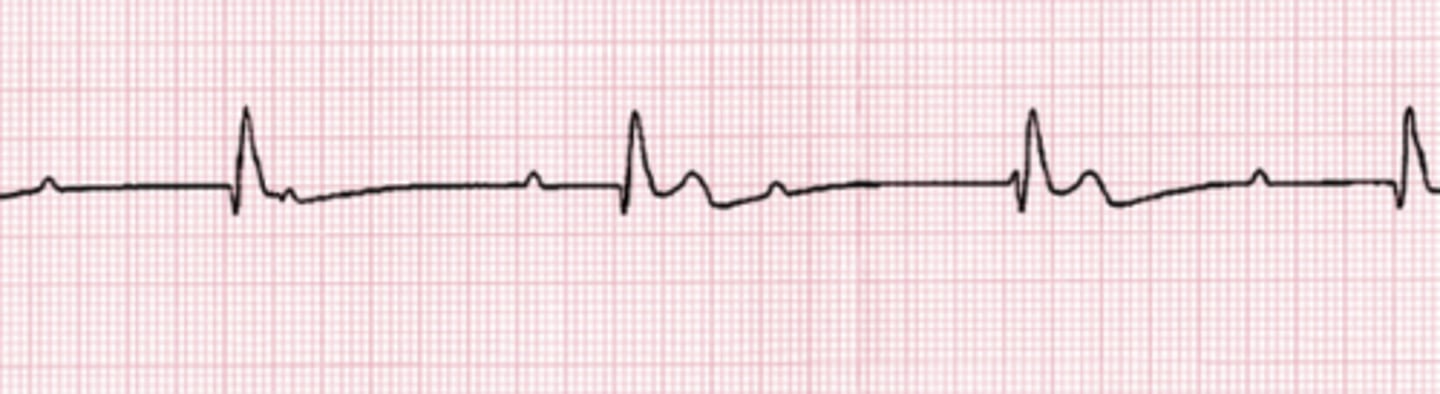 <p>Third-degree AV block</p><p>In third-degree AV block, no electrical communication occurs between the atria and ventricles, thus no relationship between P waves and QRS complexes exists. The RR interval is constant. The PP interval is constant or slightly irregular, as with sinus arrhythmia. If pacemaker cells in the AV junction simulate ventricular contraction, the QRS complexes will be narrow (less than 120 milliseconds in duration). Impulses that originate in the ventricles produce wide, bizarre QRS complexes. This arrhythmia may result from damage caused by myocardial infarction.</p>