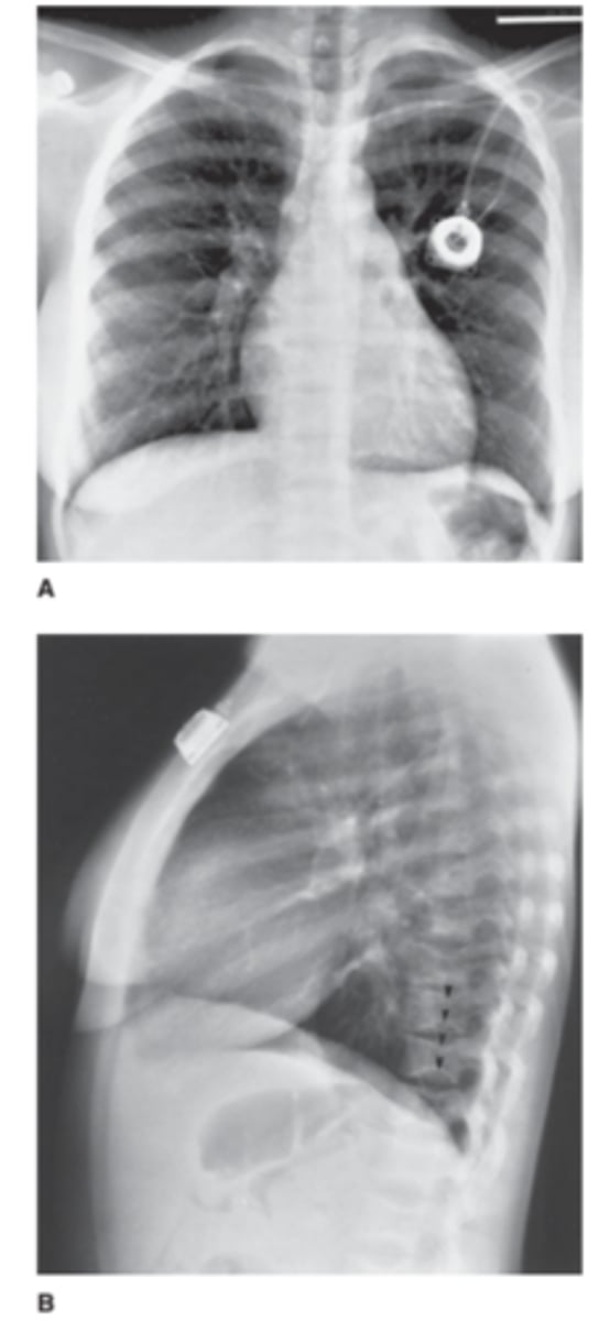 <p>For Case 6-12 (Figure 6-30), there is no evidence of</p><p>pneumonia, but there are several abnormalities that</p><p>are clues to the nature of this patient's chronic illness.</p><p>Which finding is such a clue?</p><p>A. The presence of a central venous line</p><p>B. Enlargement of the pulmonary artery segment of</p><p>the mediastinum</p><p>C. Depression in the endplates of numerous vertebrae</p><p>D. Asymmetry of the breast shadows</p>