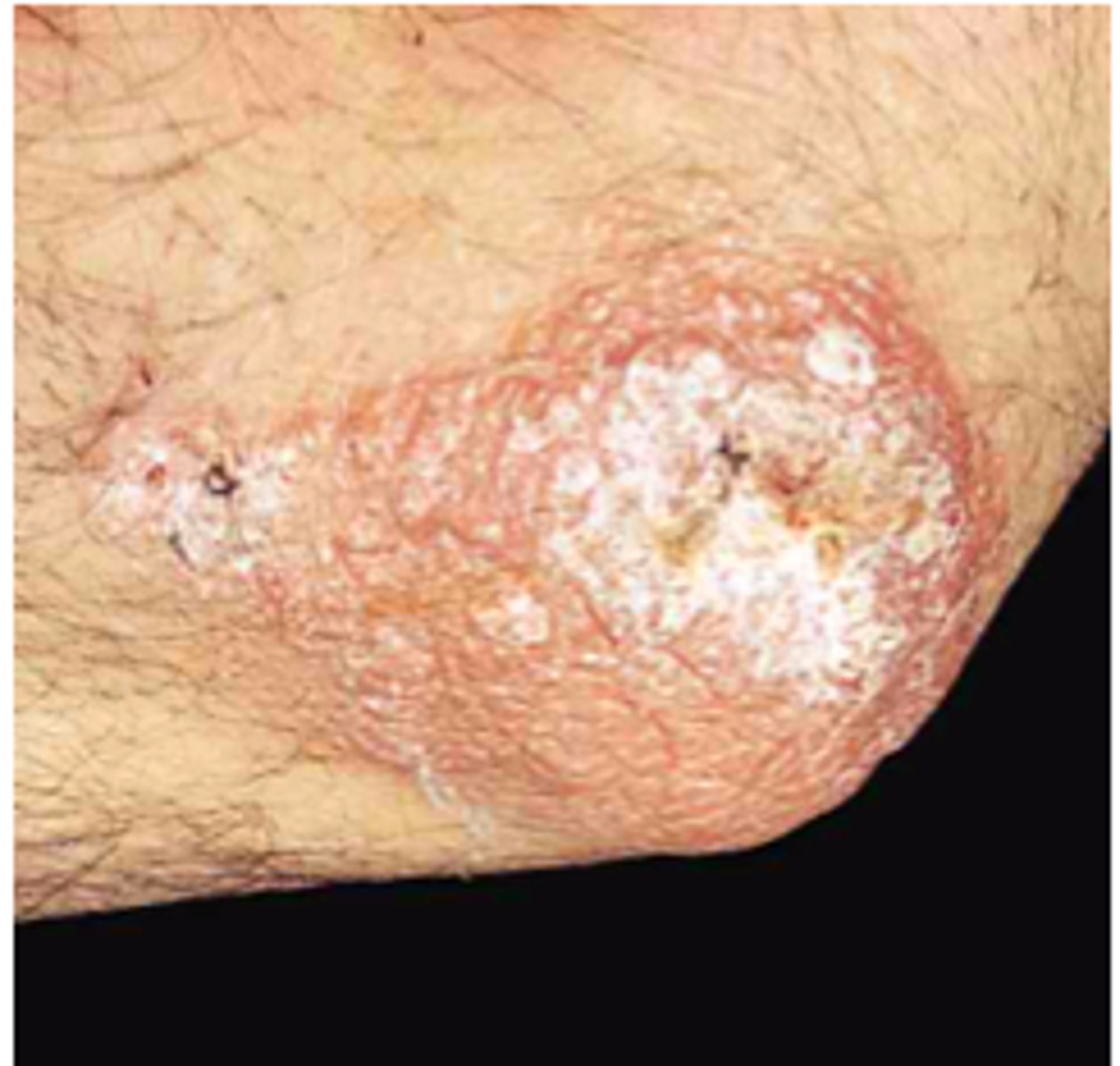 <p>Tuberculosis verrucosa cutis</p>