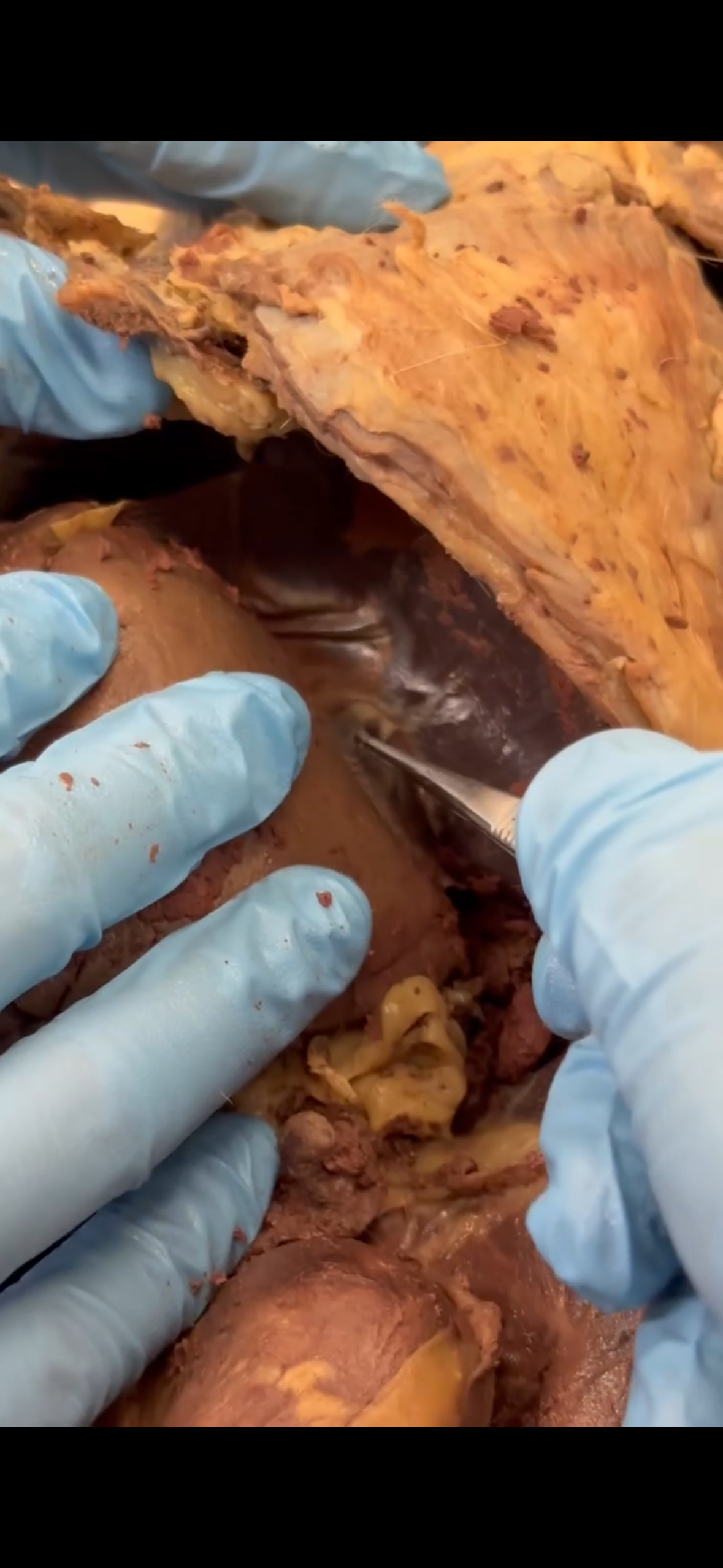 <p>What ligament is this fascae looking thing (fingers are covering the liver)</p>