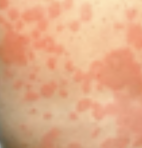 <p>Configuration of Skin Lesion</p><ul><li><p><strong>Itchiness</strong></p></li><li><p>Tends to <strong>merge together</strong></p></li><li><p>E.g., pruritic ___ macular lesion</p></li><li><p>Pruritus itchiness</p></li></ul><p></p>