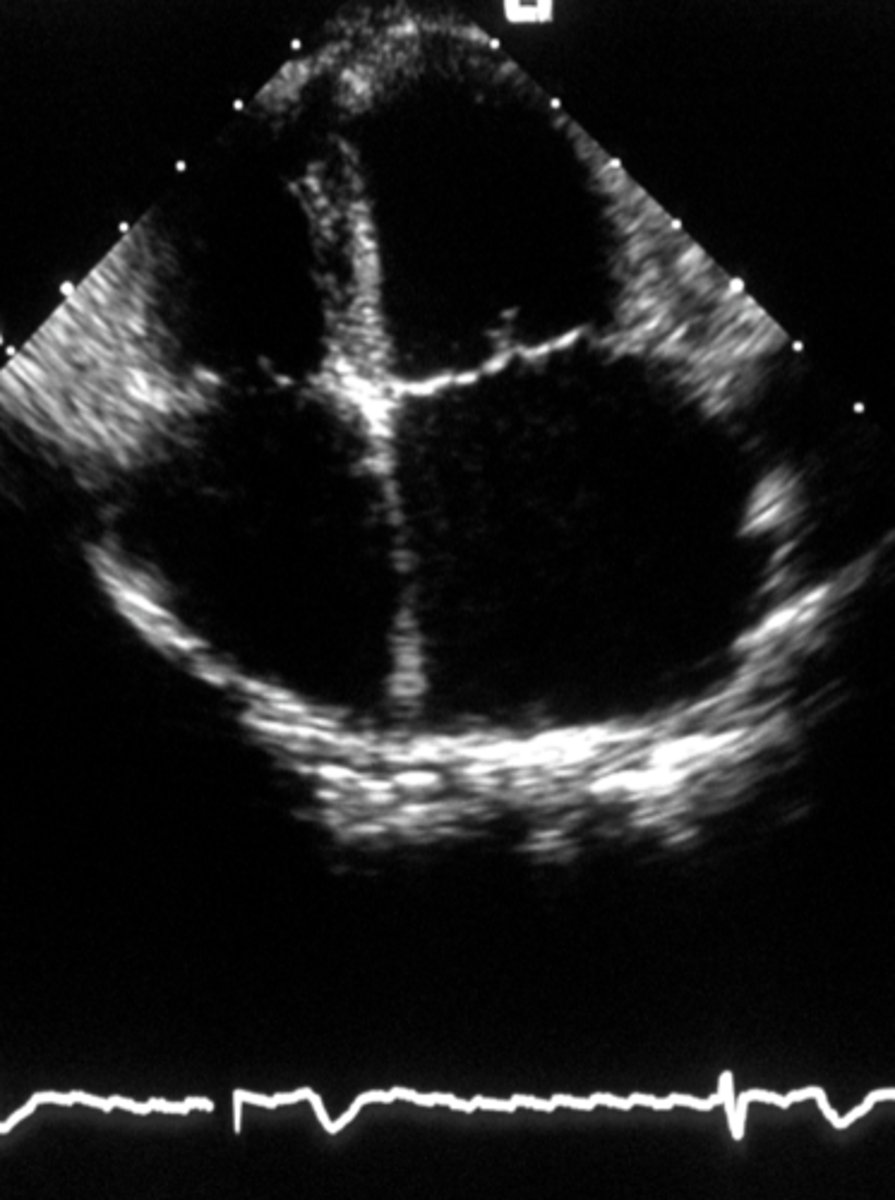 <p>tricupsid and mitral valve</p>