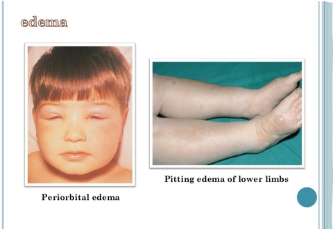 <p>What does this refer to</p><ul><li><p>HTN</p></li><li><p>Edema – anasarca in severe cases</p></li><li><p>Leukonychia</p></li></ul><p></p>