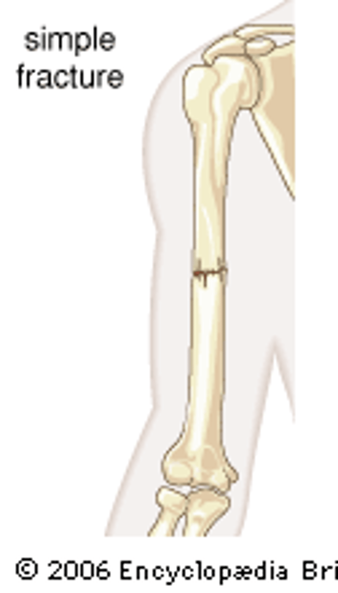 <p>Bone does not break through skin (closed fracture)</p>