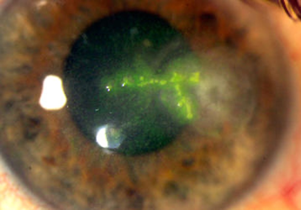 <p>True or false? Dendritic corneal ulceration is caused by the herpes zoster virus. </p>