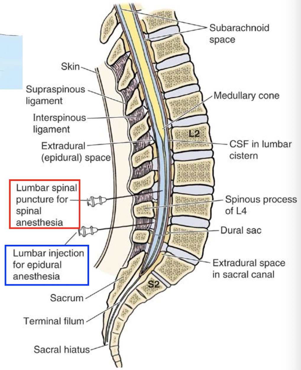 <p>into subarachnoid space. lumbar cistern full of CSF</p><p></p><p>person in tightly flexed posture; allows for more space between spinous processes of lumbar vertebra</p><p></p><p>needle inserted at L3/L4 or L4/L5 below conus medullaris; needle may encounter cauda equina nerve roots but they will move out of the way</p>