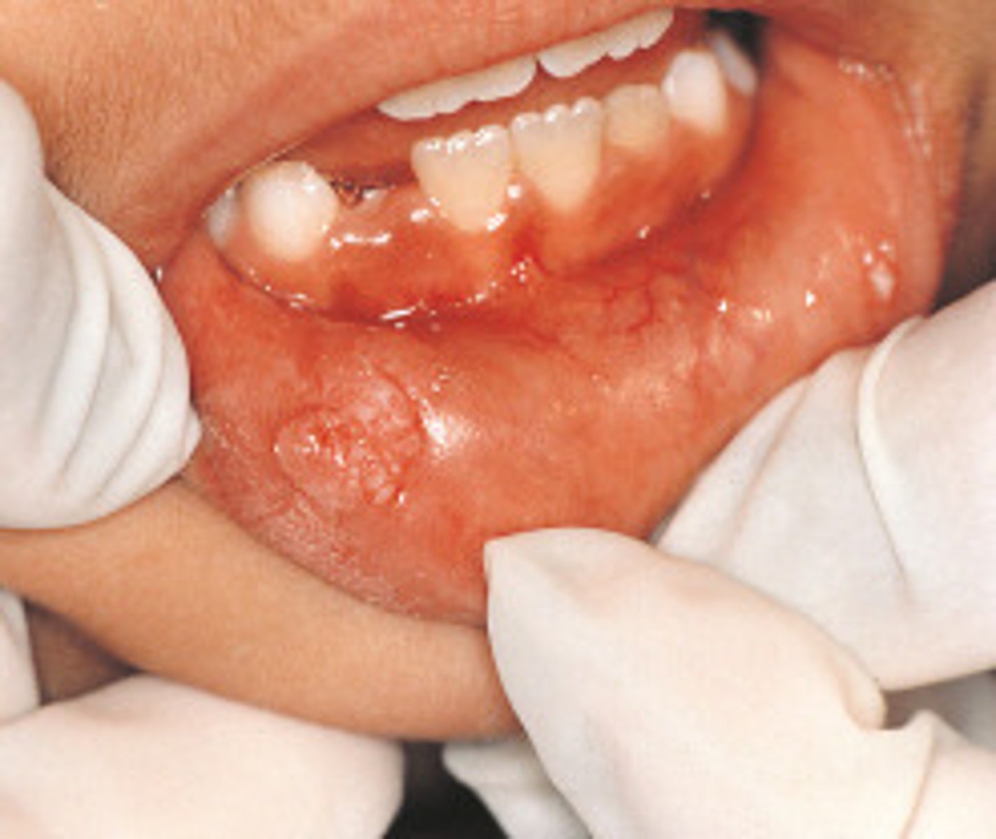 <p>Pink, papillary lesion(s), more diffuse than papilloma</p><p>lesion that appears as a result of human papilloma virus; on the skin, lesions appear as cauliflower-like warts, and on mucous membranes, they have a flat appearance; also known as venereal or genital warts</p>