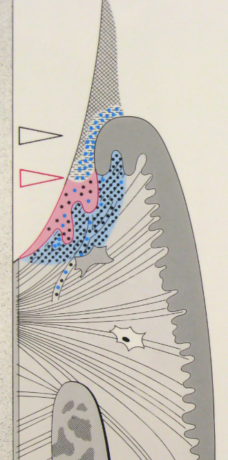 <ul><li><p>Build up of G+ AND G- anaerobic bacteria</p></li><li><p>JE migrates both laterally + apically</p></li><li><p>Acute inflammatory alterations, further increase of crevicular fluid flow, increase in PMNs, formation of wall PMNs</p></li><li><p>Severe fibroblast damage, further collagen loss with exudate</p></li><li><p>Alveolar bone WNL</p></li></ul><p></p>