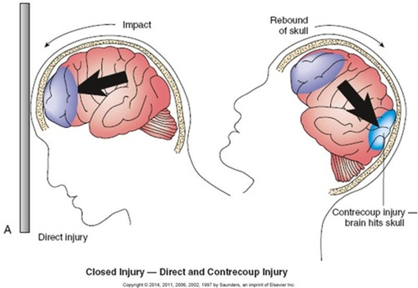 <p>the brain is injured but the skull is NOT BROKEN, fractured, or penetrated</p><p>- the dura is NOT torn</p>