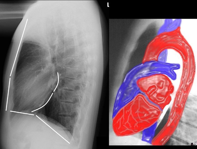 <p>In a lateral chest x ray the coronary sinus is orientated _____ and located near the ______ aspect of the heart</p>