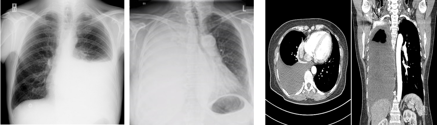 Radiopaque appearance on chest x-ray

Dark grey appearance on chest CT
