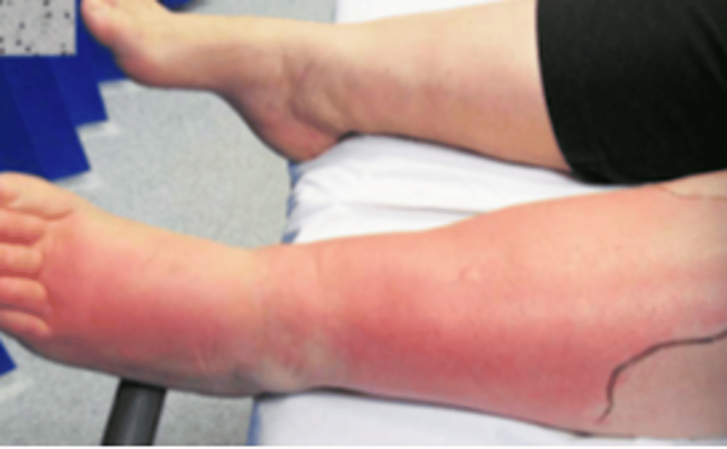 <p>Bacterial ID:</p><p>Subjective:</p><p>- Skin redness, swelling, warmth</p><p>- Pain to area</p><p>If severe: fever</p>