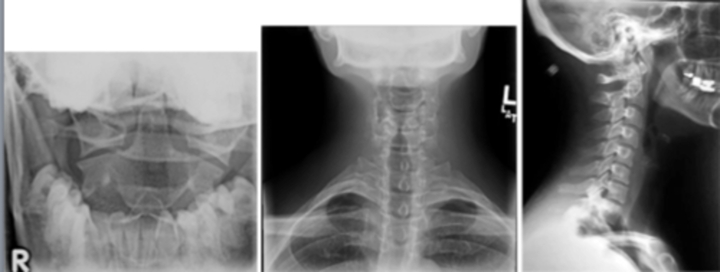 <p>immobilize neck with C-collar</p><p>xray- lateral, spinal fracture/subluxation</p><p>CT- usually performed rather than xray, fractures</p>
