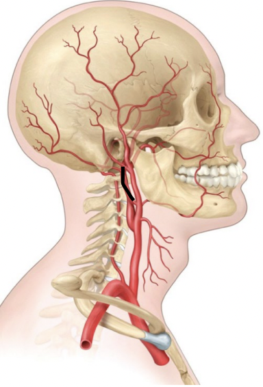 <p>An artery that enters the skull to supply blood to the brain.</p>