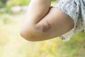 bruise, blood and serum (?) breaking down
