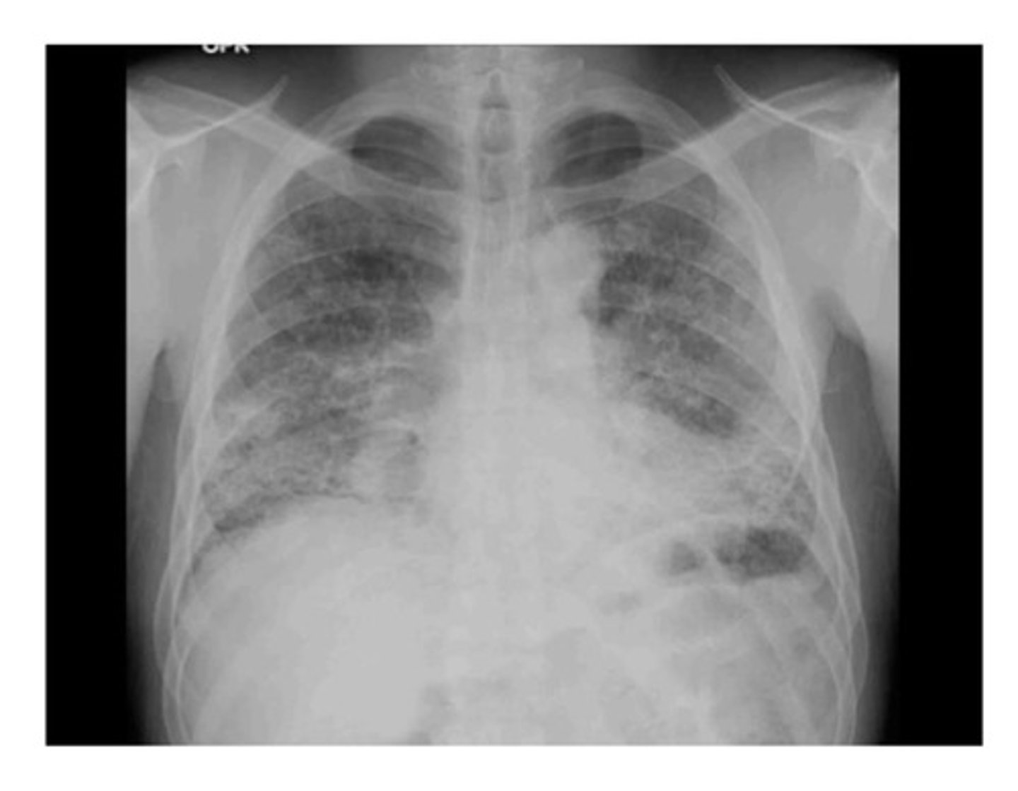 <p>1) lung fields are small (should normally occupy the space of 8-10 ribs)</p><p>2) lung fields are dense: this is usually described as "diffuse bilateral reticular opacities" (net-like) and is seen throughout the lungs, but denser at the bases compared with the apices</p><p>3) "hilar prominence" meaning that hilar areas are denser, especially on the right. this is likely from enlarged lymph nodes</p><p>4) heart is pushed upward; overlaying lymphadenopathy</p>