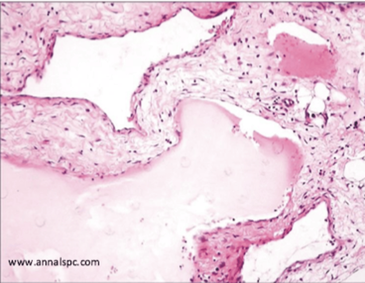 <p>neck or axilla of children</p><p>massively dilated spaces with CT stroma and lymphoid aggregates</p>