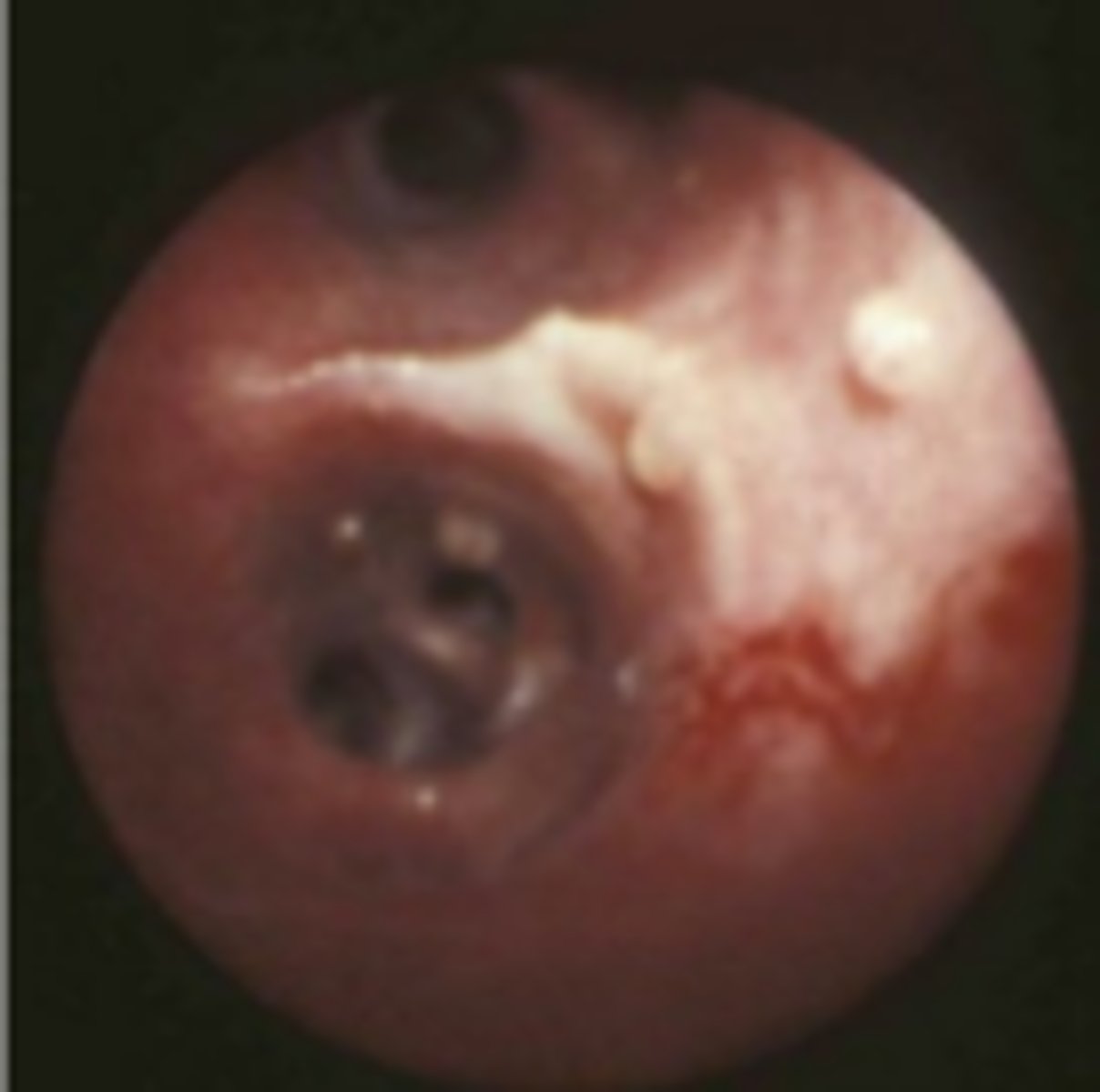 <p>Dog presents with cough, bronchoscopy revealed nodes in trachea and bronchi. What worm would cause this?</p>