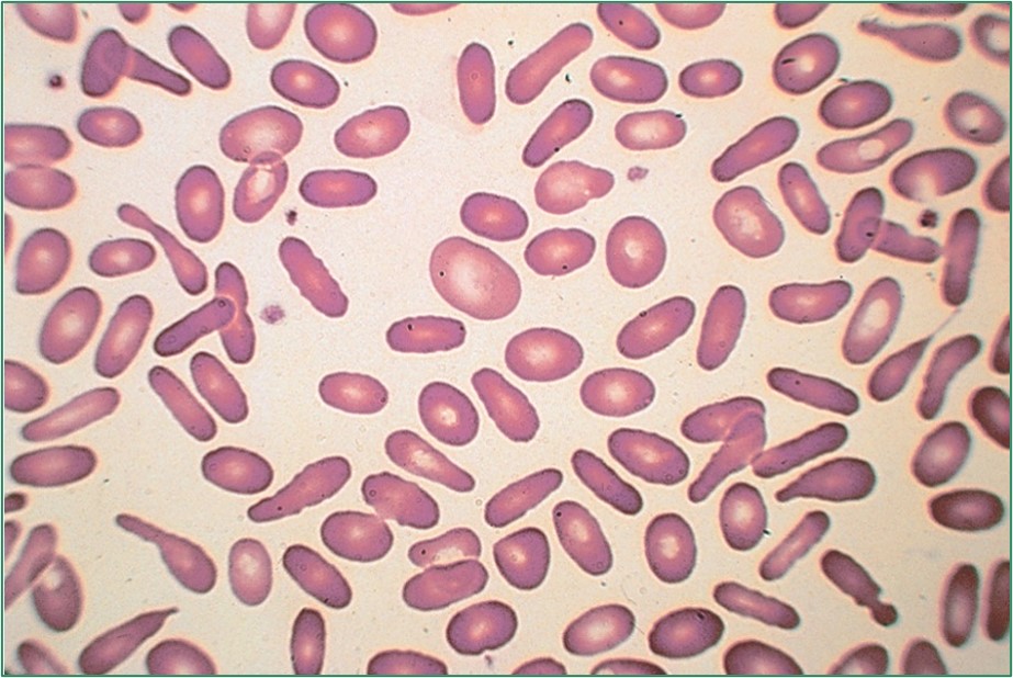 <p>What disease could cause this?</p>