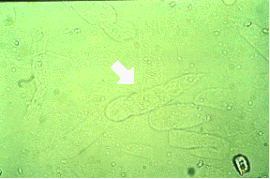 <p>Identify the urine sediment element shown by the arrow.</p><p></p><p>Mucus thread</p><p>Cylindroid</p><p>Fiber</p><p>Amorphous urates</p>