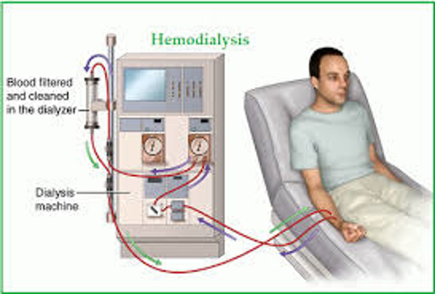 <p>a process that removes waste and excess fluid from the blood</p><p>- pts impaired kidney function (renal failure)</p><p>- two types: hemodialysis and peritoneal dialysis</p>