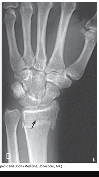 <p>What fracture is this? And what doe sit affect?</p>